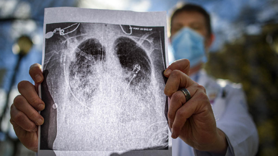 Dr. Sam Pope holds a printed Xray illustrating double lung pneumonia